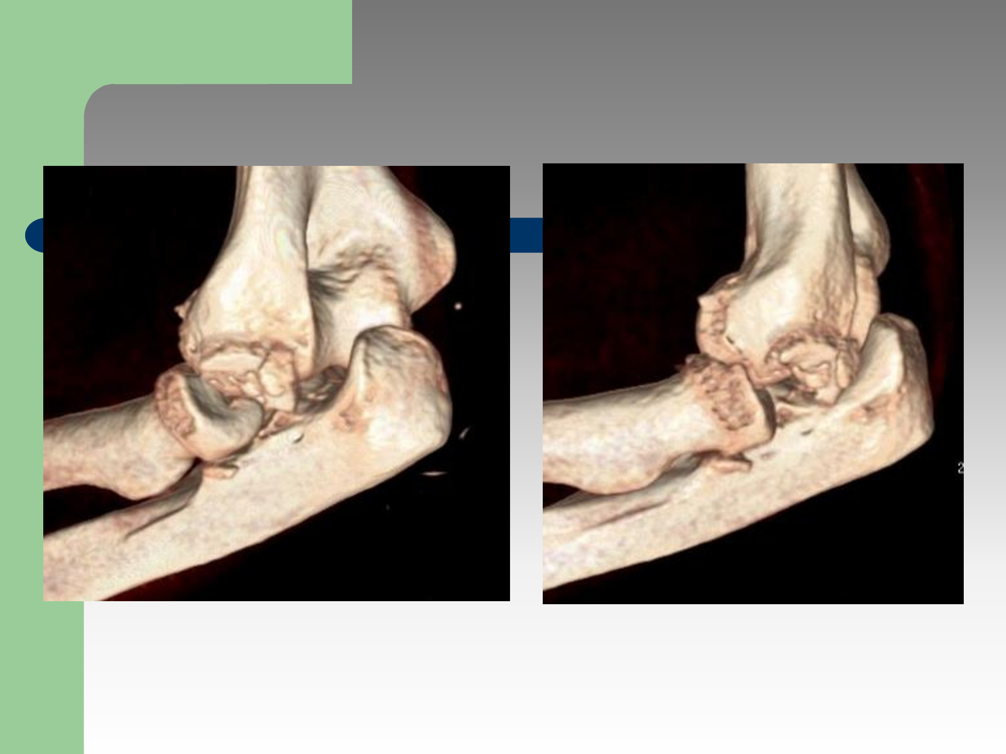 Ryc. 2 - Złamanie wieloodłamowe głowy kości promieniowej – obraz CT 3 D – wskazanie do implantacji endoprotezy